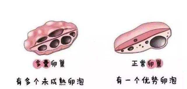 怀不上，月经不规律，还经常长痘要注意了，很可能是因为这个问题